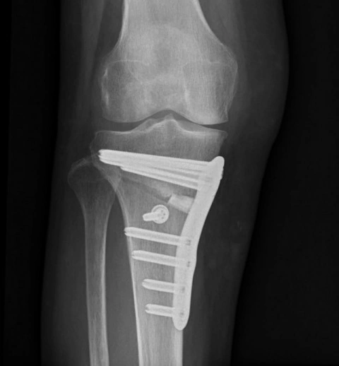 膝周囲骨切り術について