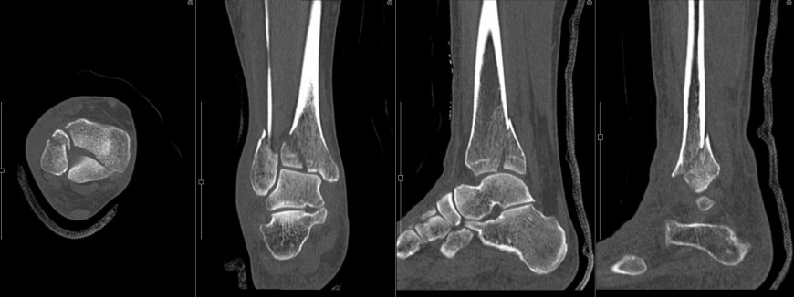 右足関節骨折 MPR