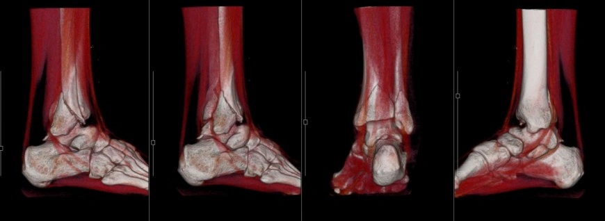 右足関節骨折 軟部条件