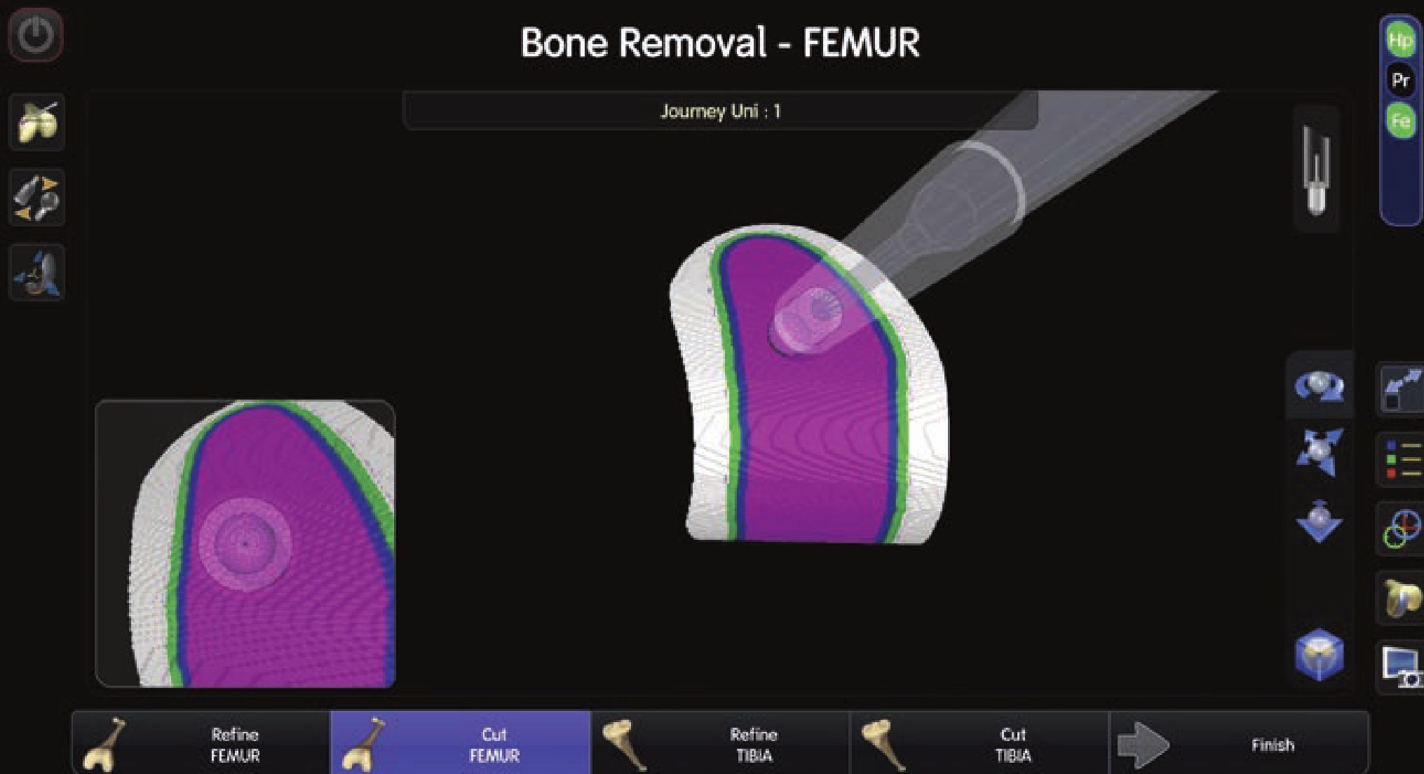 TKA用インプラント