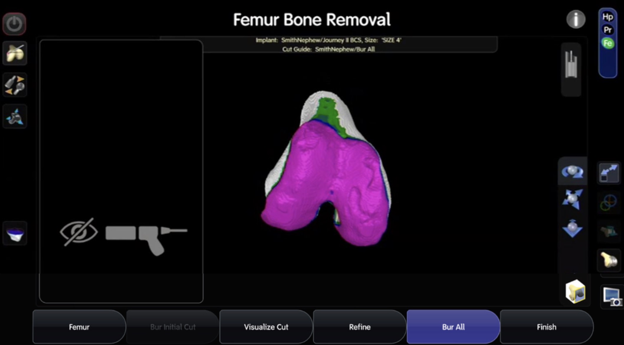 UKA用インプラント